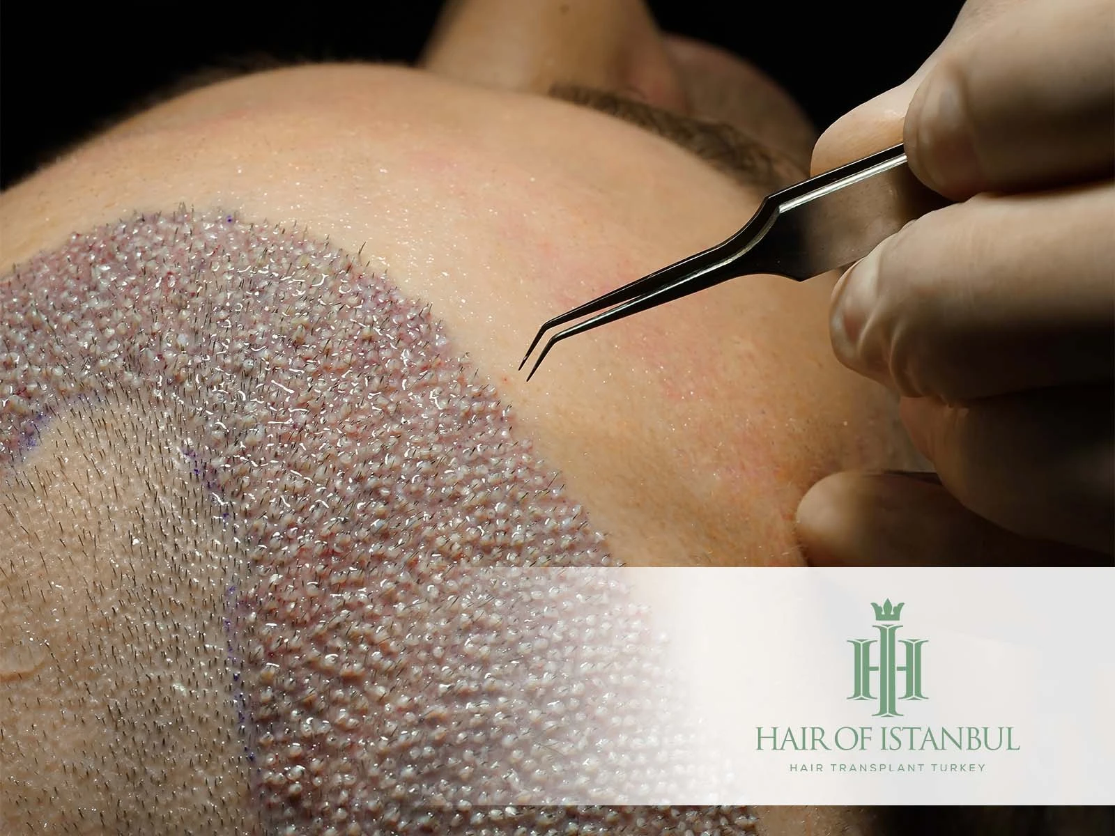 Hair Transplant Methods: FUE, DHI & More Compared in Detail