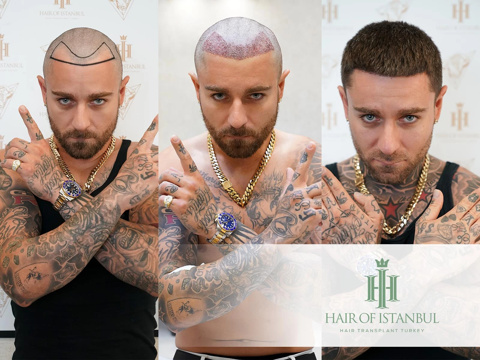 Hair Transplant Procedure: Steps, Methods & Recovery Guide