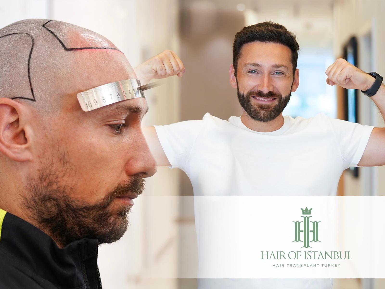 Hair Transplant Results Timeline: Month-by-Month Progress