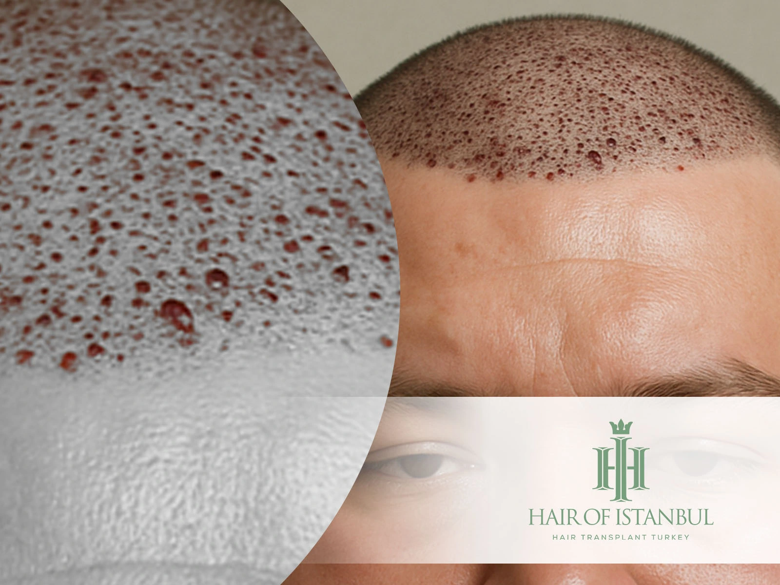 Hair Transplant Side Effects: Swelling, Redness, Shock Loss