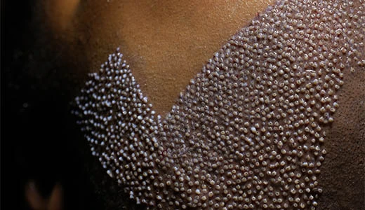 Hair Transplant Surgery Combining Art and Science