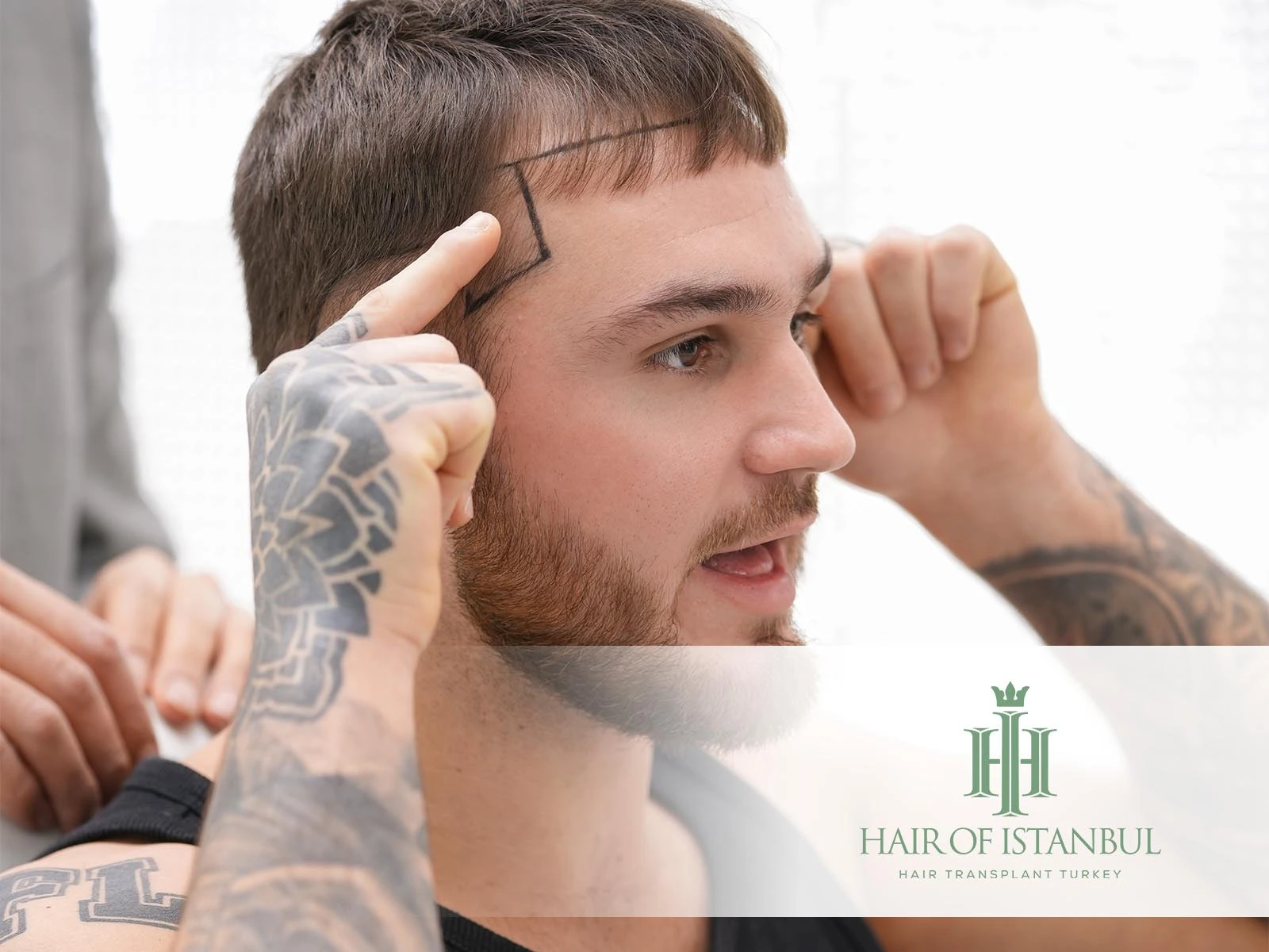 Hair Transplant Therapy: Natural, Lasting & Personalized Care