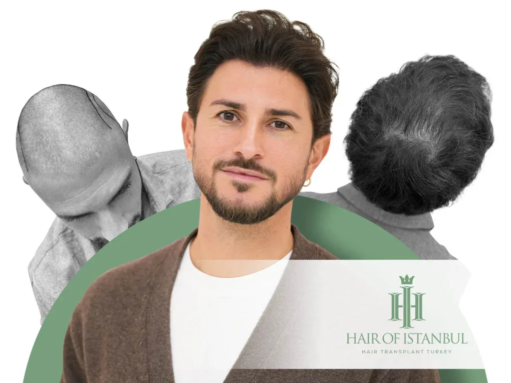 Male Hair Transplant: What Is Specific to Men