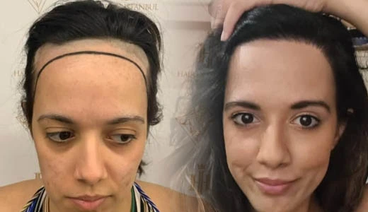 Hair Transplants for Women How Soon Will I See Results