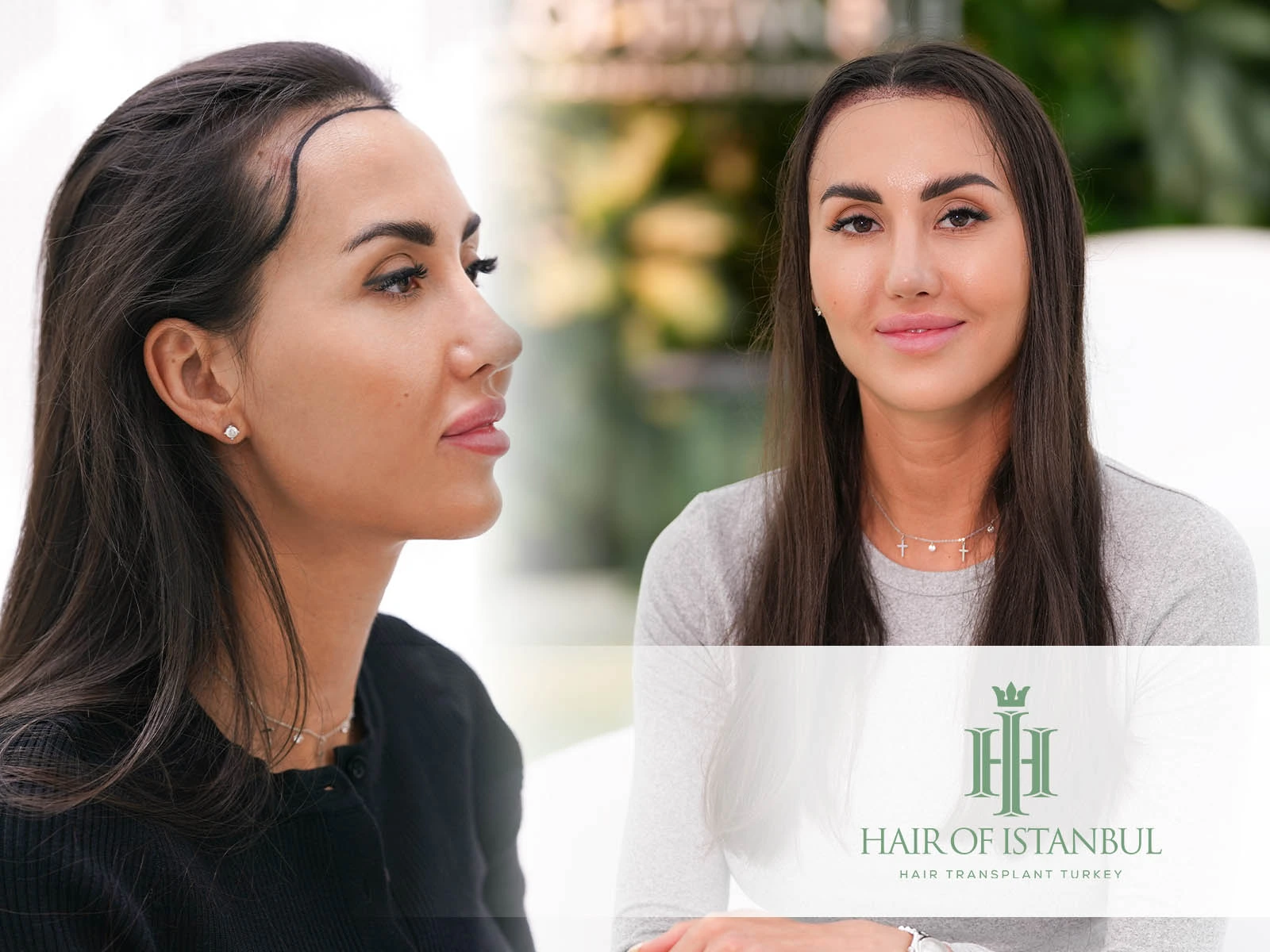 Hair Transplants for Women: Myths vs. Facts