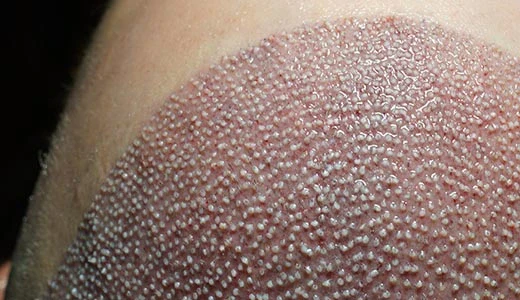 Hair Transplant Preparation: Essential Pre-Op Tips for Success 2 Hair and Scalp Hygiene Before Surgery