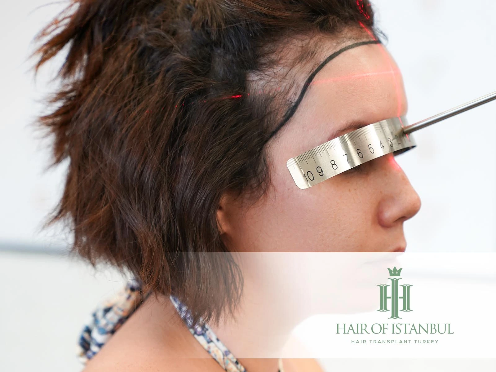 Hairline Lowering vs Women Hair Transplant: Which Solution Suits You Best?
