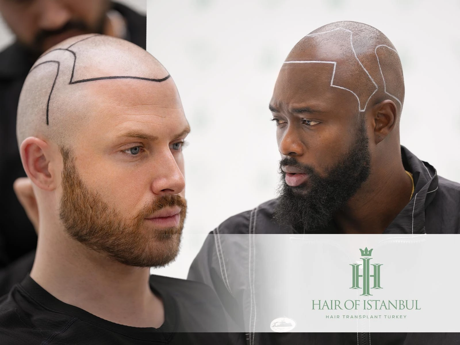 Hairline for Hair Transplant: Design and Natural Results