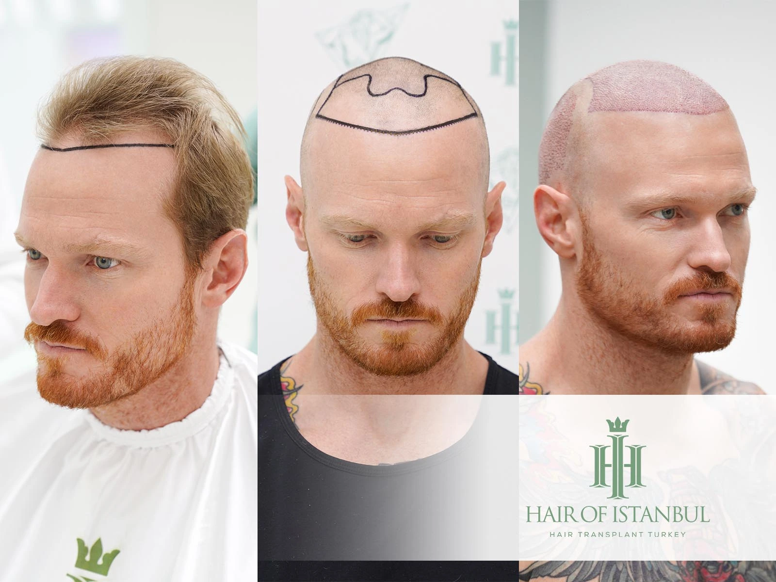 How Do They Transplant Hair? Step-by-Step Hair Restoration