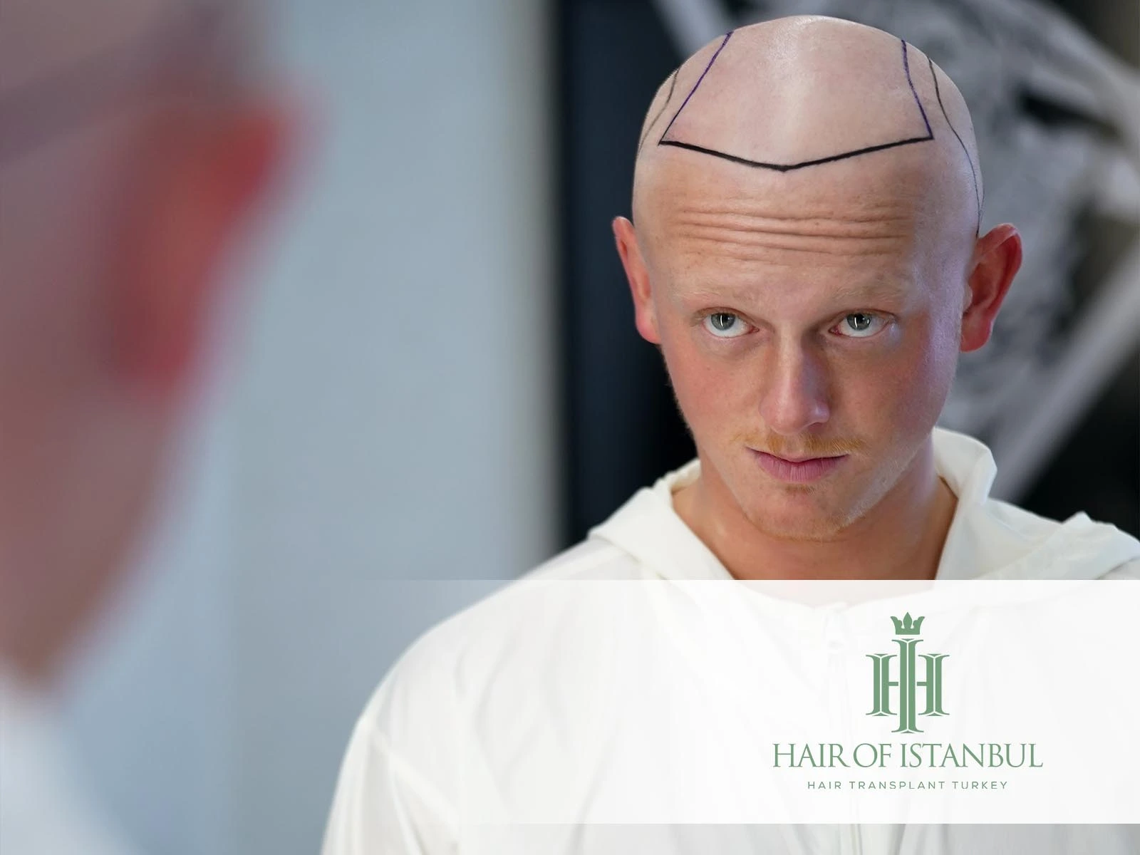 How Long Hair Transplant Last: Lifespan, Results & Factors