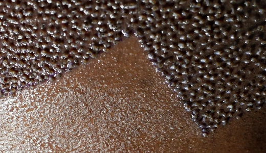 How a Hair Graft Calculator Works