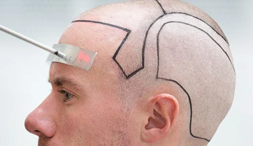 How to Prepare Your Donor Area Before Surgery