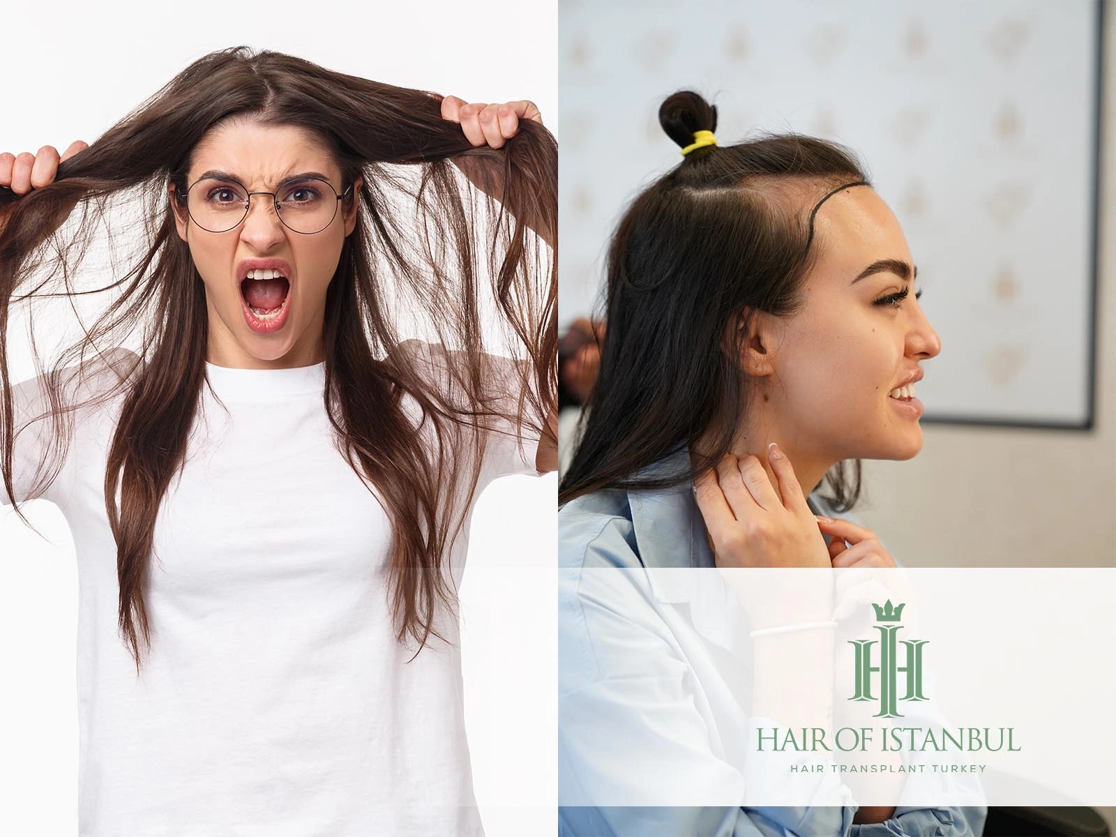 Is Hair Transplant Safe for Women with Hormonal Hair Loss?
