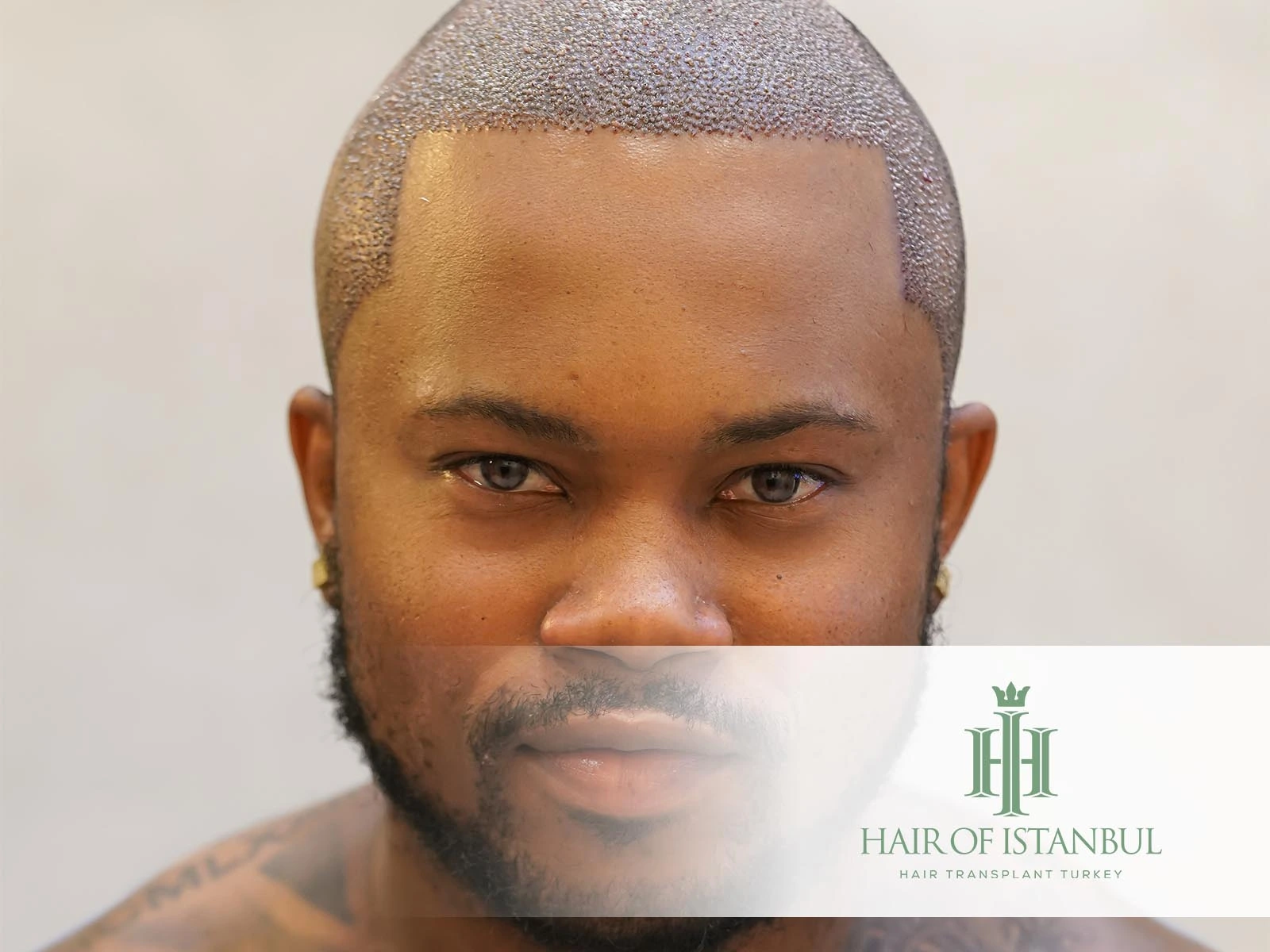 Is a Hair Transplant Permanent? Facts & Long-Term Results