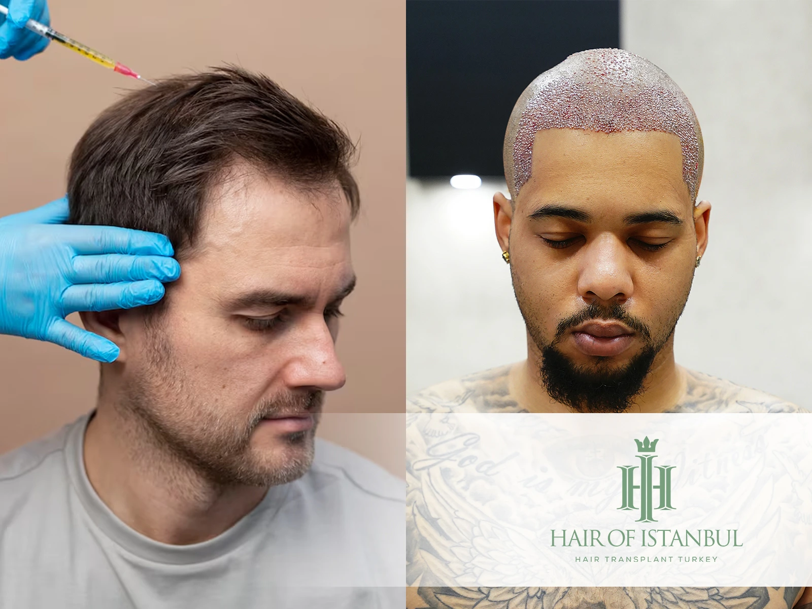 PRP or Hair Transplant: Which Treatment Is Right for You?