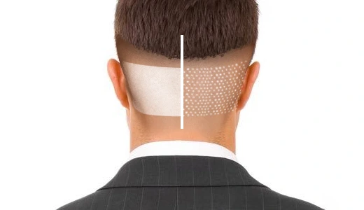 Technique Matters FUE and DHI Compared