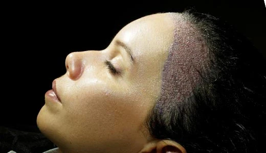 Hairline Lowering vs Women Hair Transplant: Which Solution Suits You Best? 2 What Is Hairline Lowering Surgery
