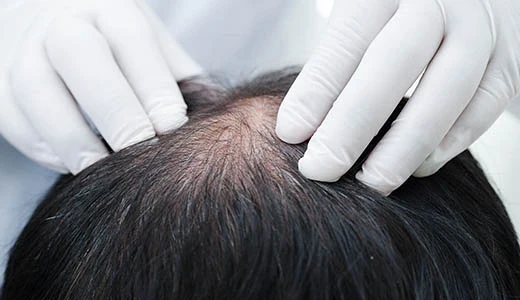 Will the Transplanted Hair Fall Out Again? The Truth Revealed 2 Why Does Transplanted Hair Fall Out