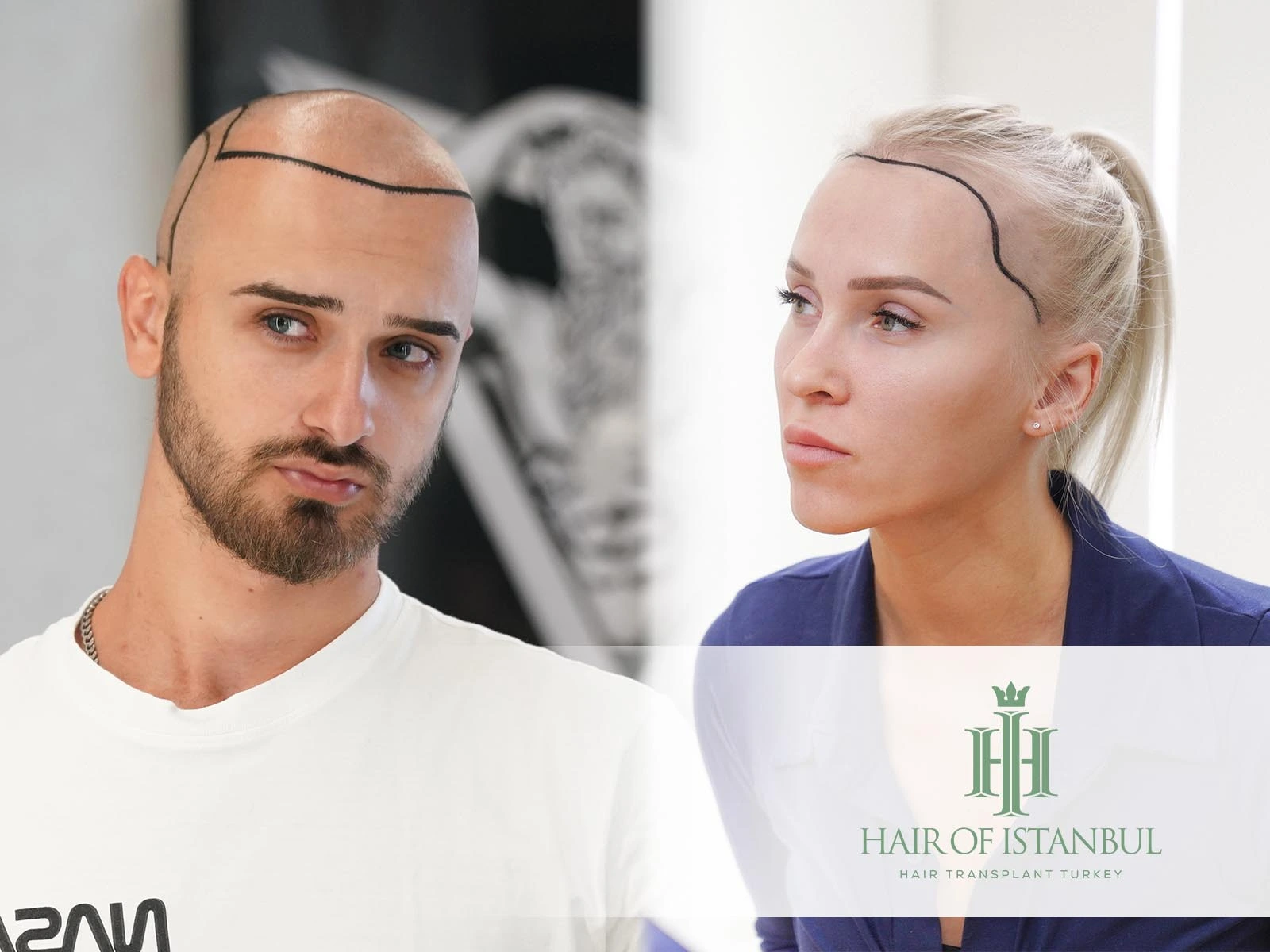 Woman vs Male Hair Transplant: What’s the Difference?