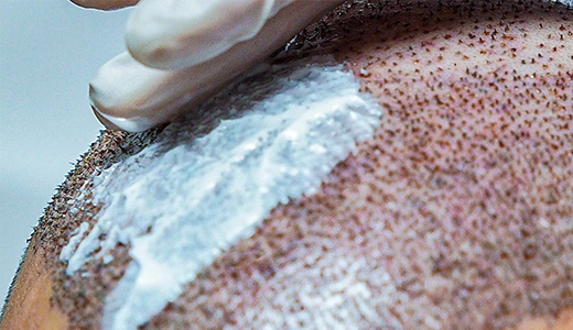 Are Hair Transplant Scabs a Sign of Infection