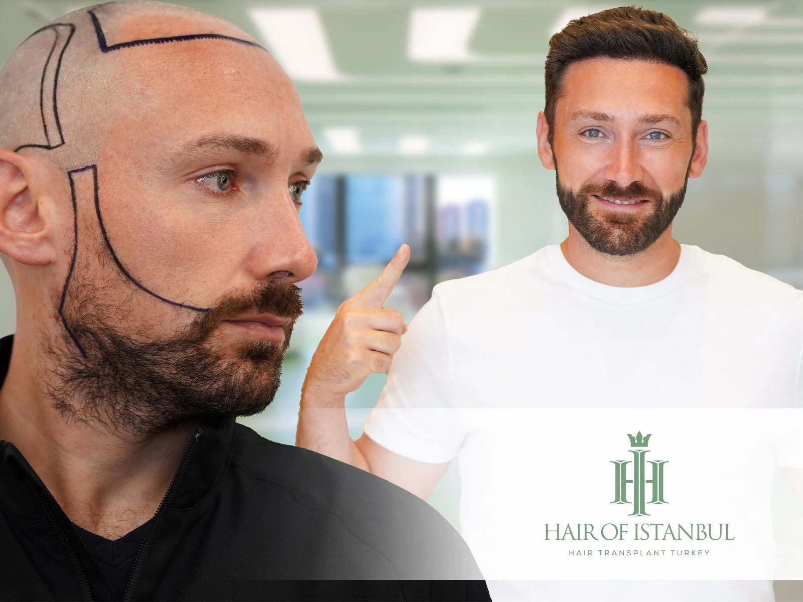 Beard Hair Transplant: Restore a Strong, Masculine Look