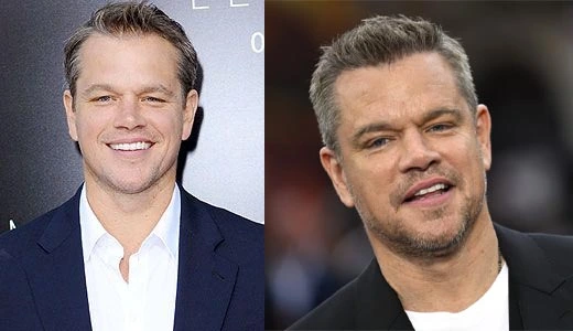 Before and After Hair Transplant Hair Transplant Famous Actors