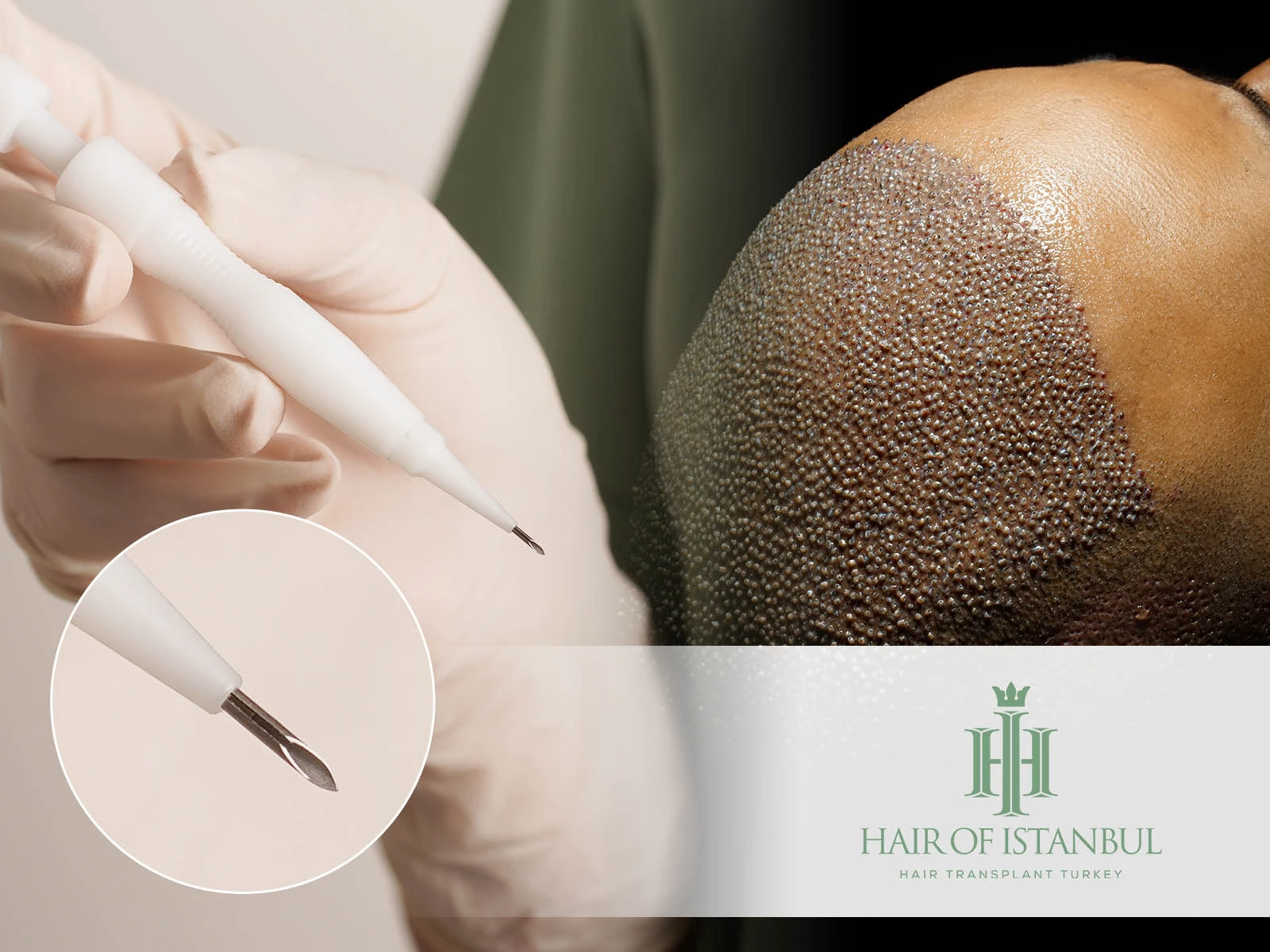 DHI Hair Transplant: Advanced Technique, Benefits & Recovery