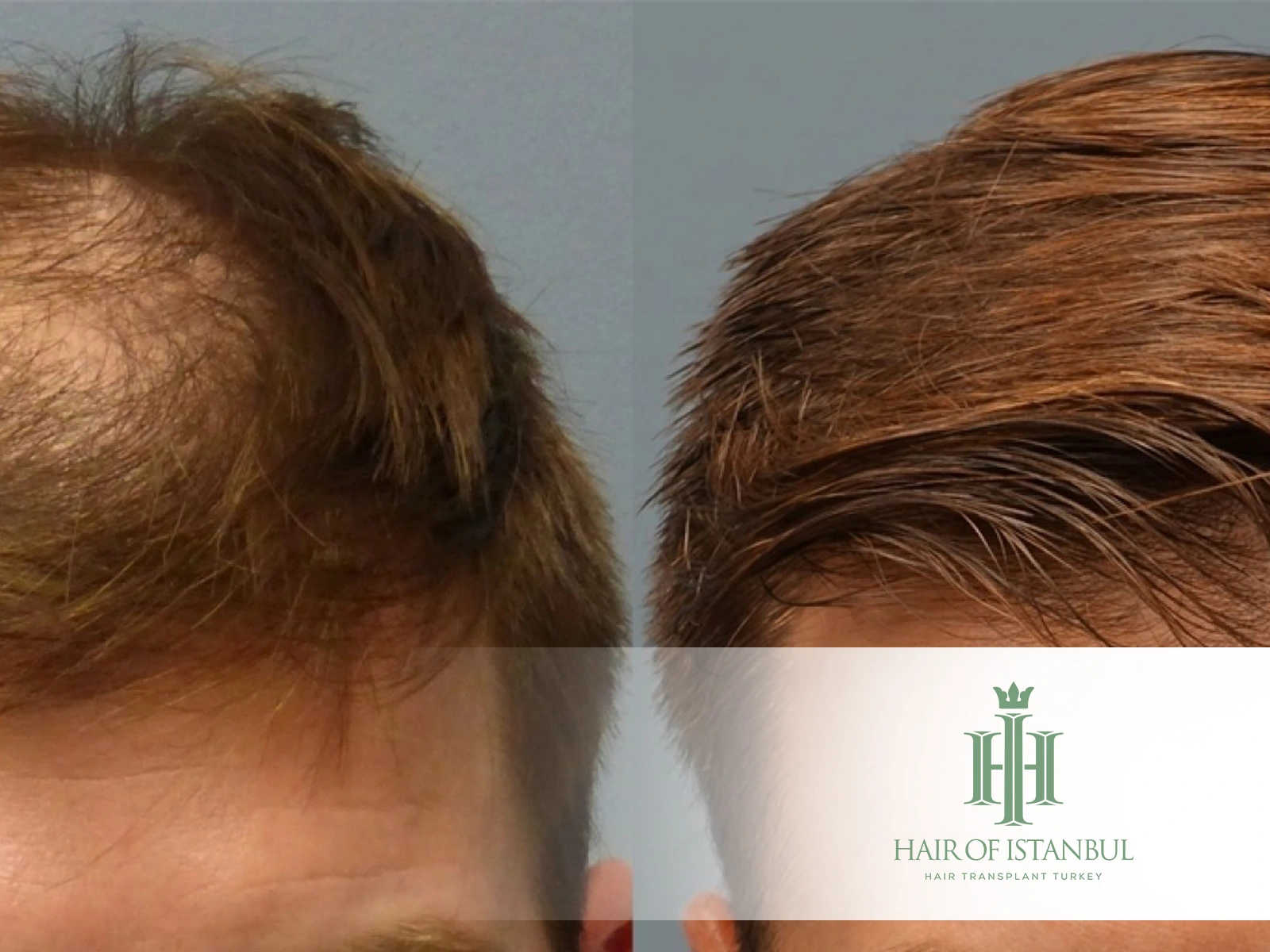 FUT Hair Transplant: Classic Method for Lasting Results