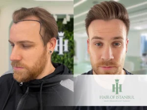 Hair Transplants for Men: Complete 2025 Guide 6 Hair Transplant Before After Real Results & Recovery Guide