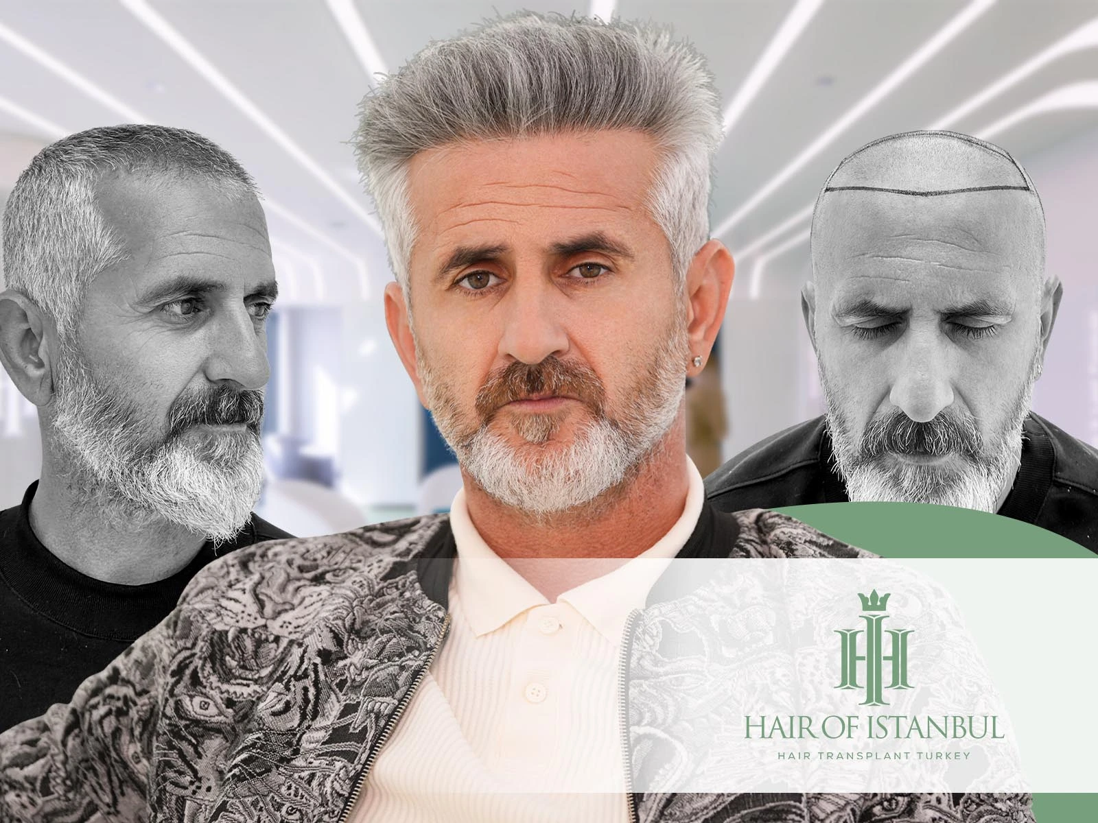 Hair Transplant Before After: What to Expect from Start to Finish