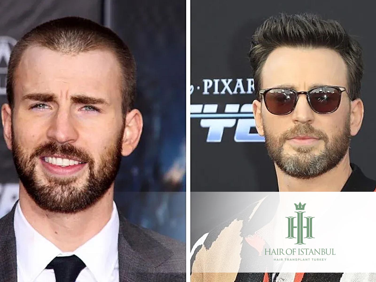 Hair Transplant Famous Actors: Secrets of Their New Look
