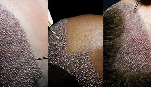 Hair-Transplant-Holes-and-Different-Hair-Types