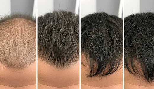 Hair Transplant Results Timeline