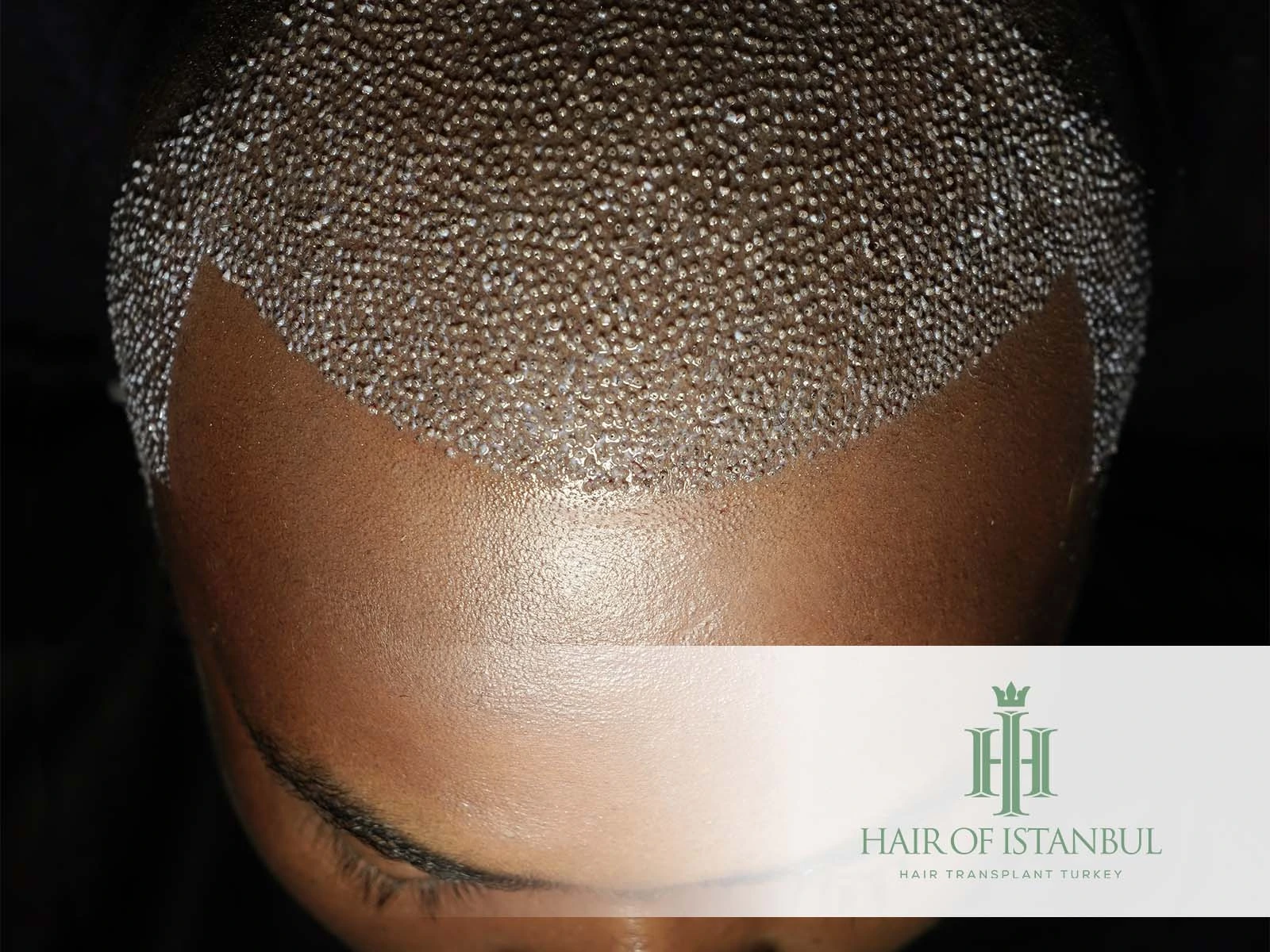 Hair Transplant Scabs: Healing, Care, and What to Expect