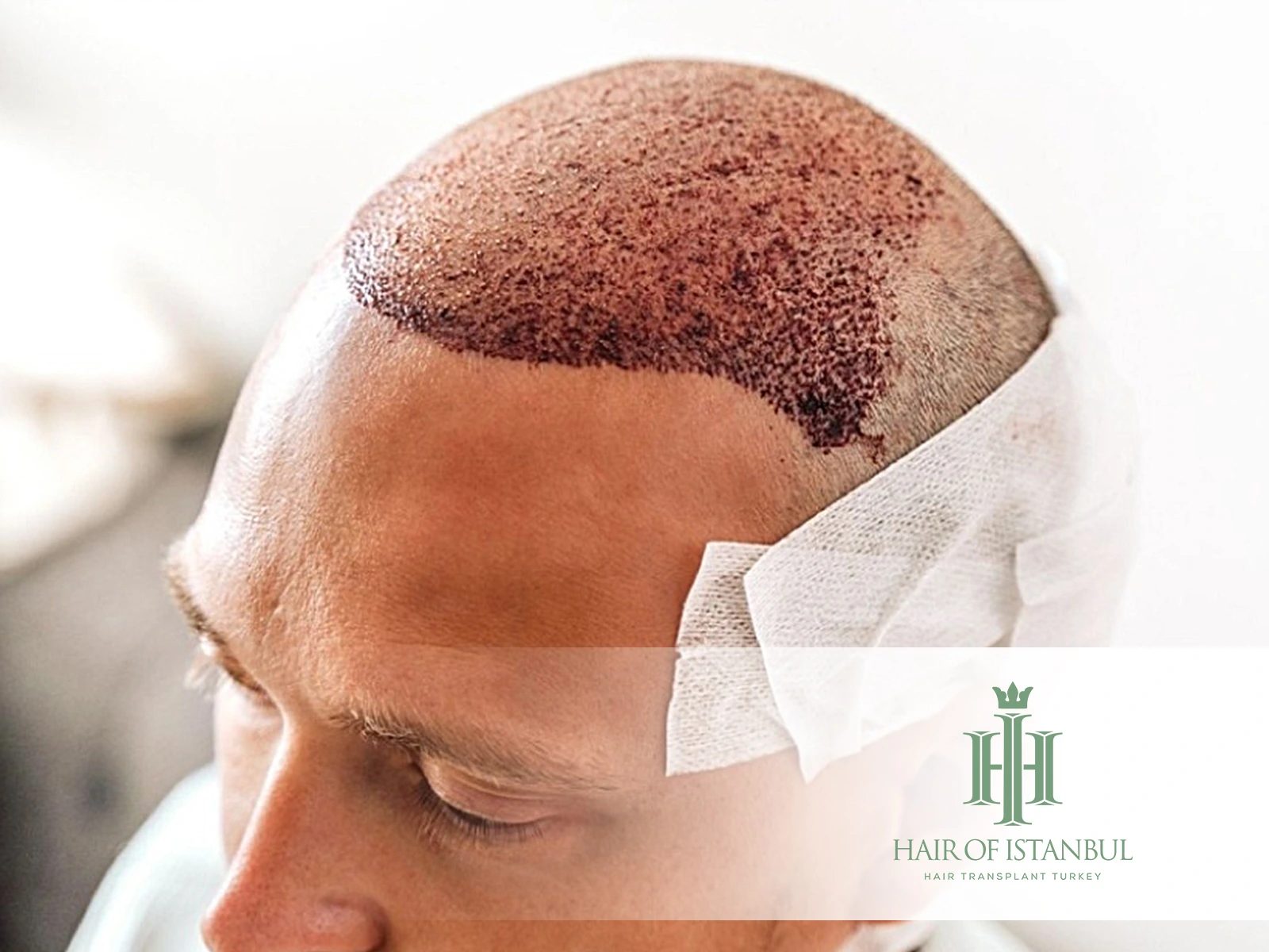 Hair Transplant Scabs: Healing, Care, and What to Expect