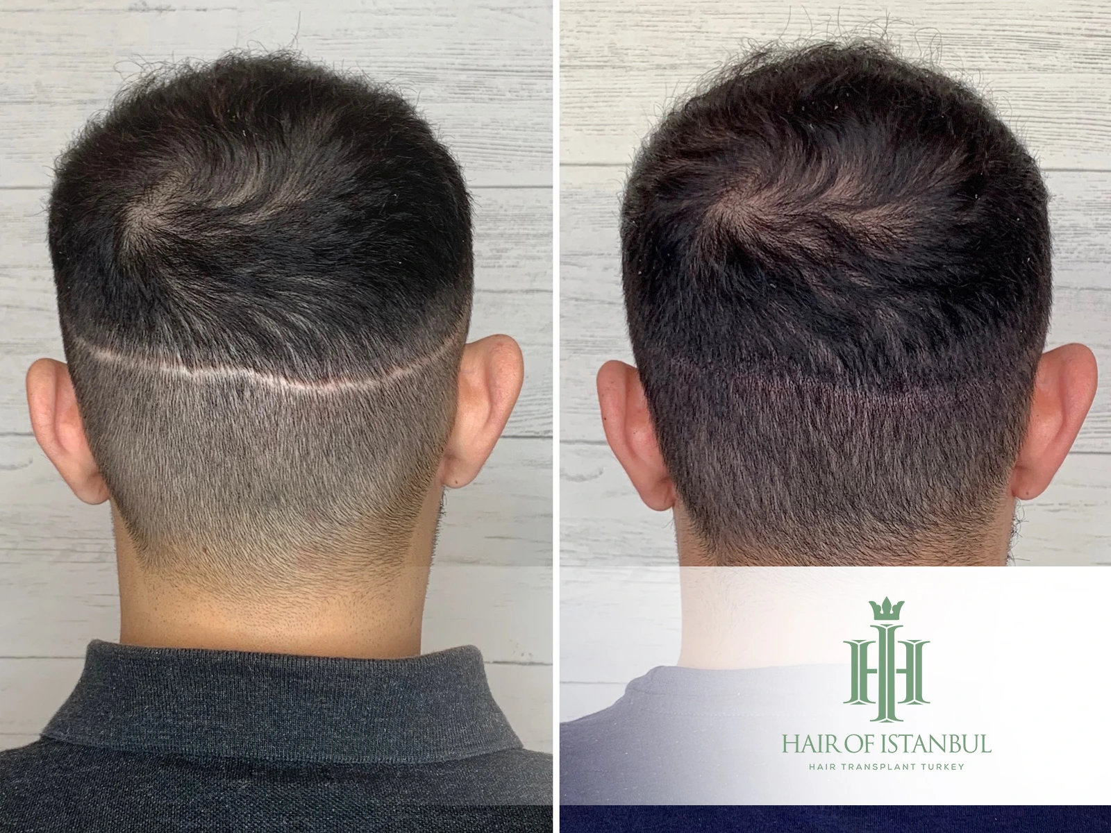 Hair Transplant Scar: Can You Get Scar-Free Restoration?