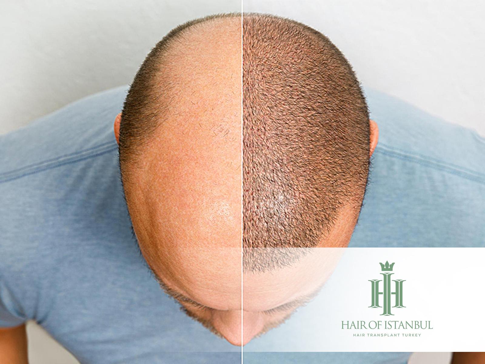 Hair Transplant Success Rate: What Determines Real Results