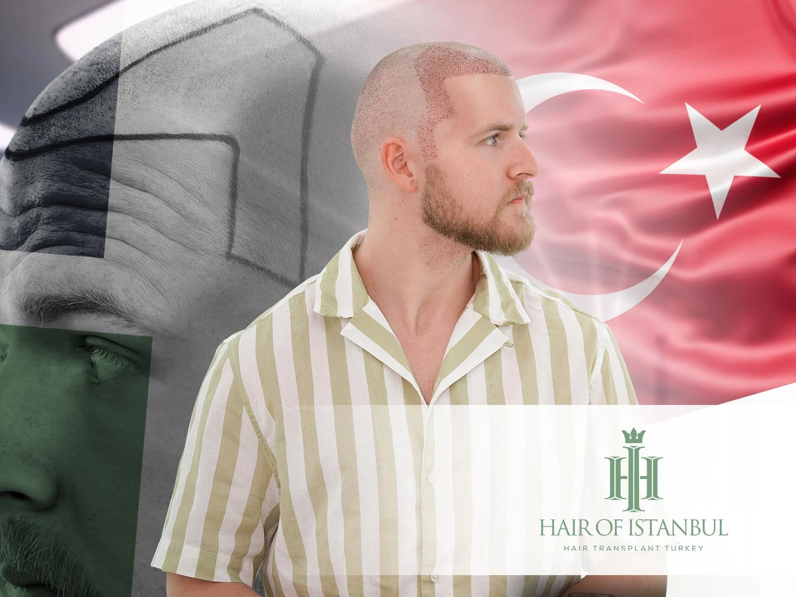 Hair Transplant Turkey: Techniques, Clinics & Results