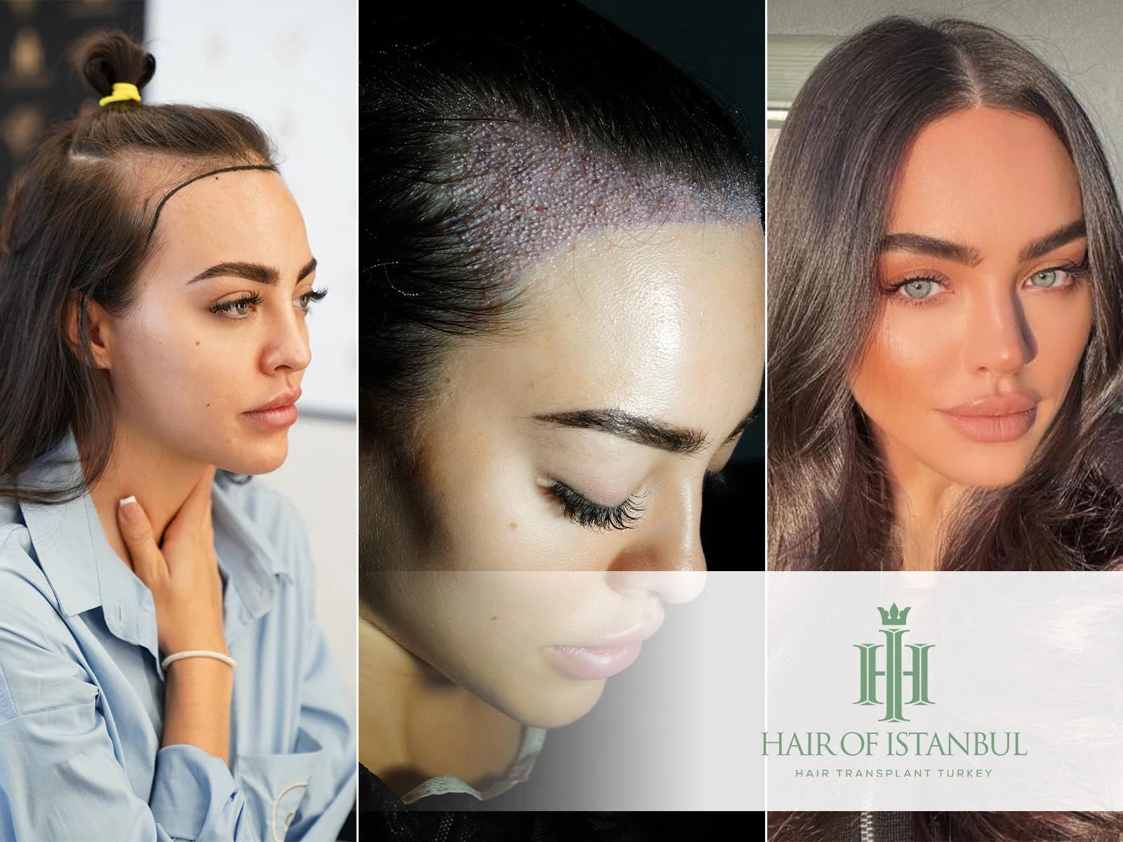 Hair Transplant and Forehead Reduction in Women Guide