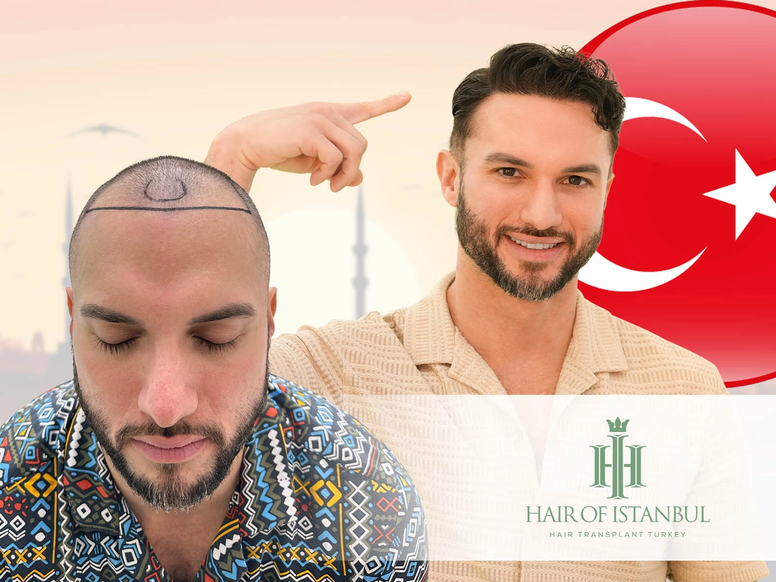 Hair Transplant in Turkey
