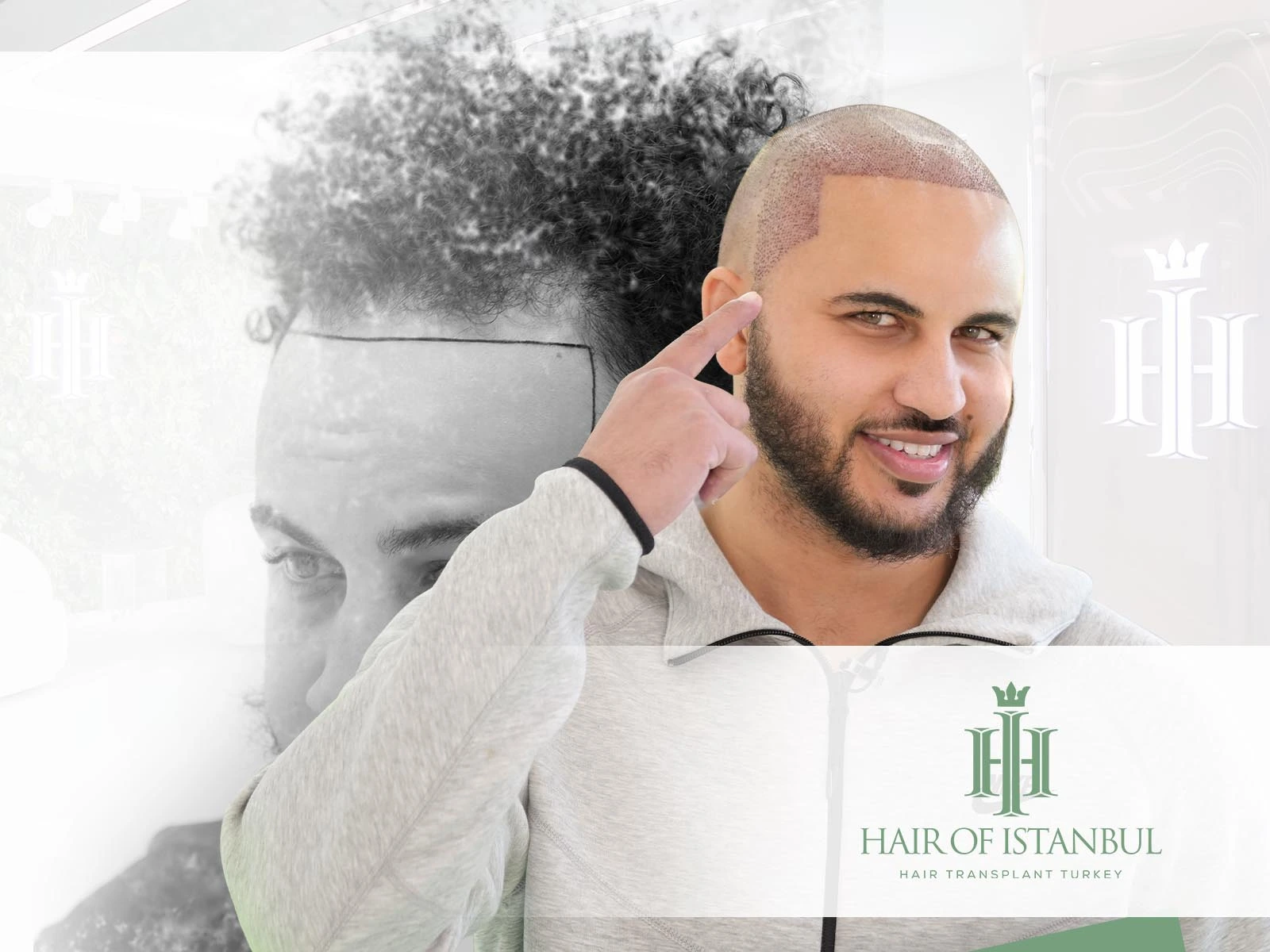 Hair Transplants: Comprehensive Guide to Techniques, Recovery and Results