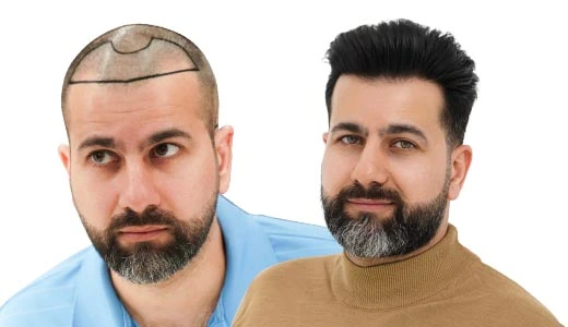 Reviewing Before After Variations by Hair Type