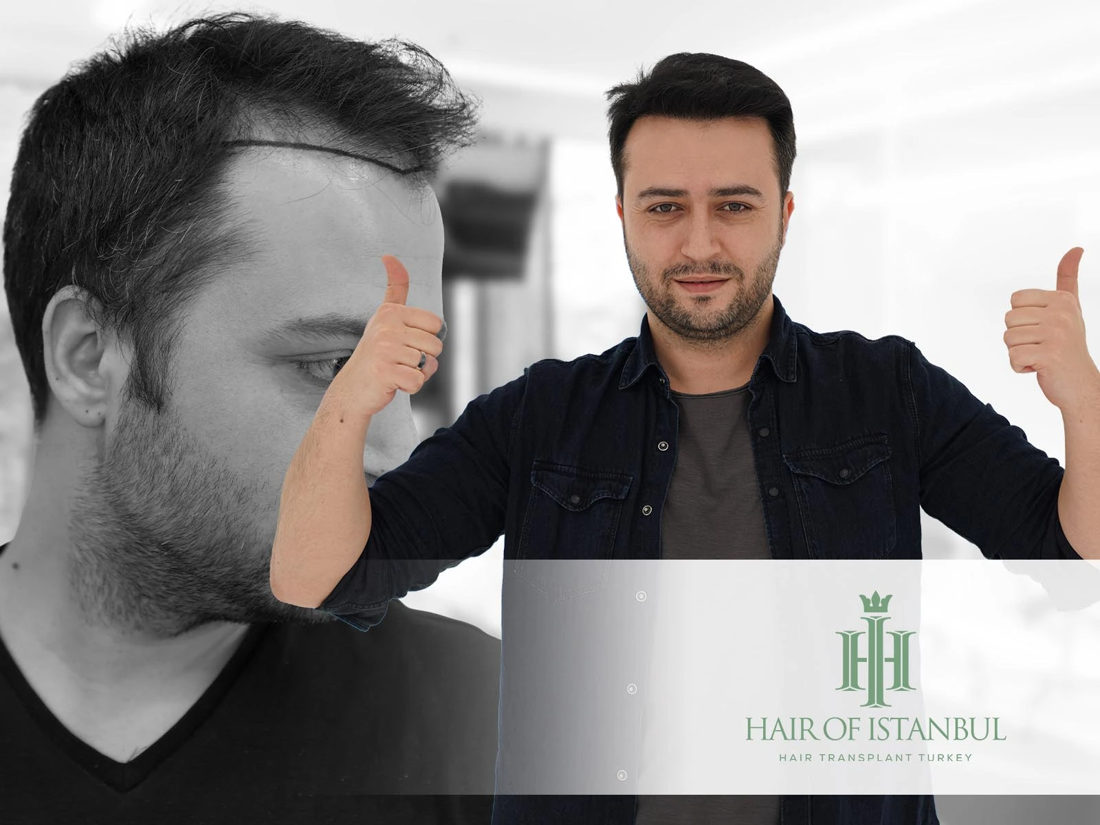 Saç Dökülmesine Kesin Çözüm Nedir? 2025 İçin Güncel ve Etkili Yöntemler