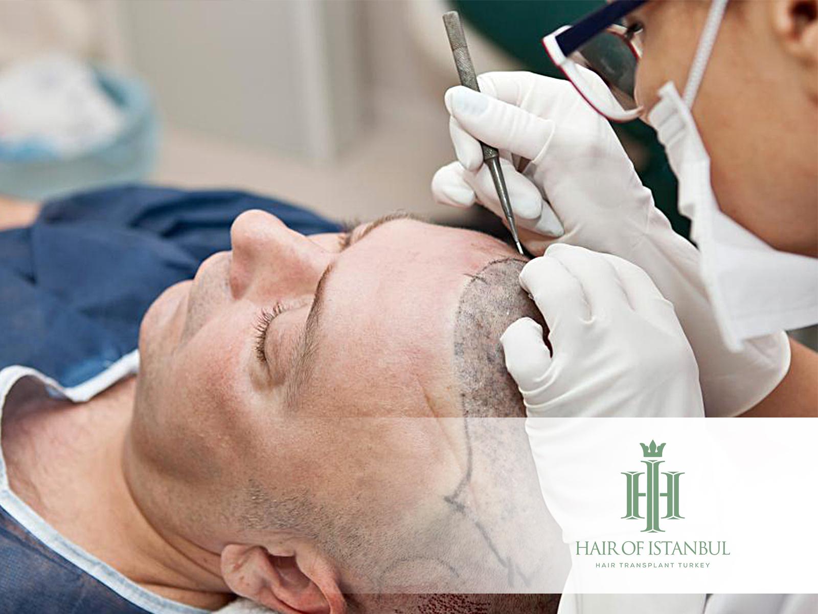 Surgical Hair Transplant: Permanent Solution for Hair Loss