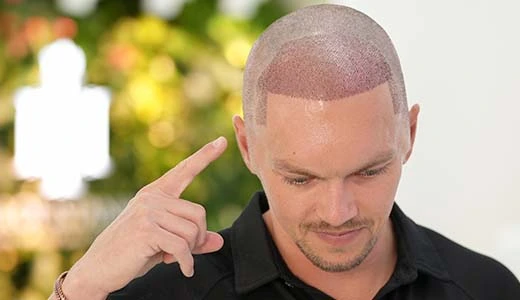 Hair Transplant Therapy: Natural, Lasting & Personalized Care 2 What Is Hair Transplant Therapy