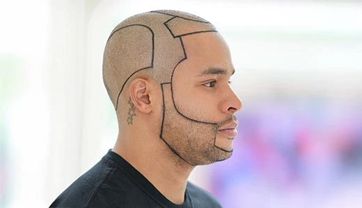 Qué motiva a los hombres a elegir un trasplante de barba