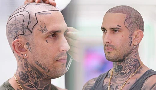 Best Hair Transplant in Turkey - What to Expect During Your Hair Transplant Journey