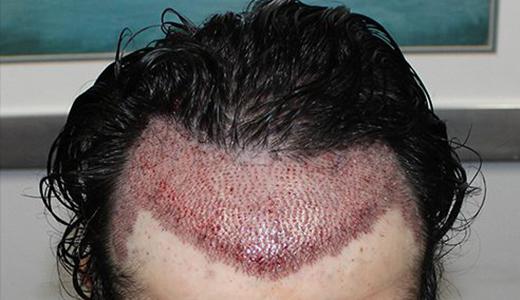 What to Expect During a Hair Transplant