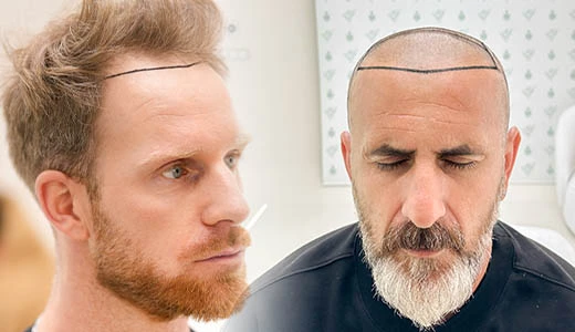 Who Is a Candidate for Hair Transplant Treatment