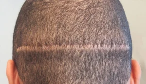 Hair Transplant Methods: Modern Techniques Compared in 2025 3 Who Should Consider FUT Hair Transplant